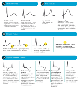 Ecg Interpretation Made Simple Moc Stepwise Approach
