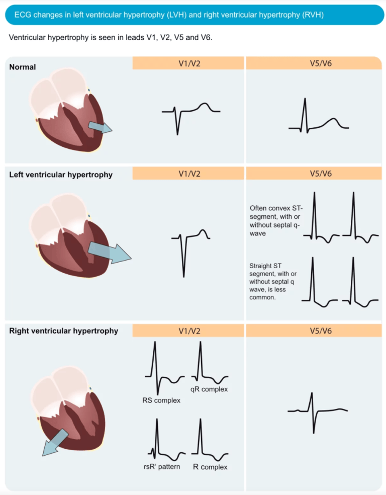 ECG Interpretation Made Simple – MOC Stepwise Approach